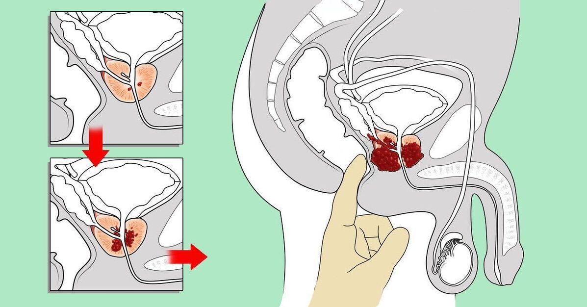 como massagear a próstata